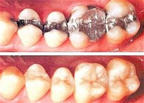 Untuk mengatasi gangguan ini anda memerlukan obat gusi bengkak karena gigi berlubang yang tepat sesuai dengan seberapa parah sakit gigi yang anda alami. Rawatan - Klinik Pergigian Halizah