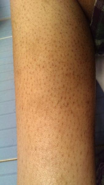 I Have Dark Spots On My Legs Like Hair Follicles What Can I Do To