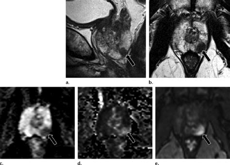 Perform a gastrointestinal examination if indicated. Images of a 65-year-old man with a prostate nodule ...