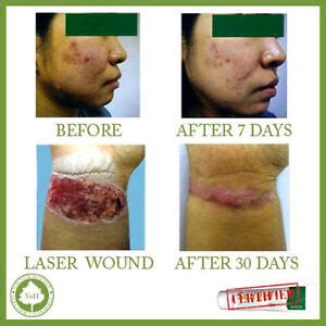 The sensitive gigi hair removal cream for the face is perfect size for travel. Best SCAR REMOVAL cream for ACNE SCARS / MARKS/ BURN on ...