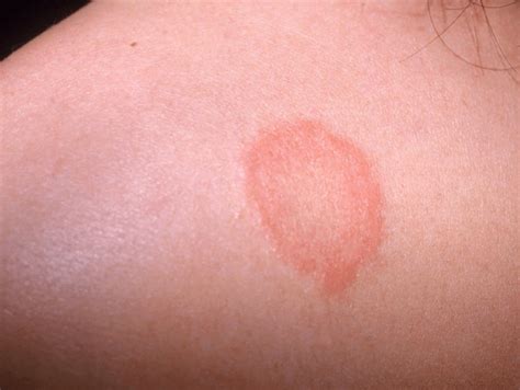 Afflicted babies will often fuss during a diaper change. Red Spots on Skin Not Itchy, Tiny, Pictures, Petechiae ...