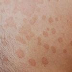Hautausschlag auf grund von hefepilzen zeigt sich in etwa in schuppenden, farblich veränderten flecken, die sich wie bei der kleienpilzflechte (pityriasis versicolor) gleichmäßig ausbreiten. RINGVORMIGE HUIDAFWIJKINGEN - foto's en uitleg | huidinfo ...