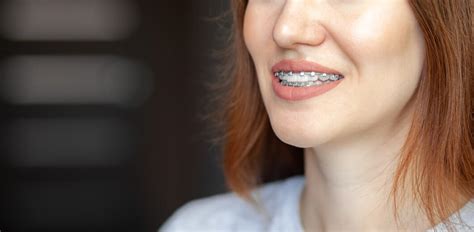 Улыбка молодой и красивой девушки с брекетами на ее белых зубах выравнивание кривых зубов с