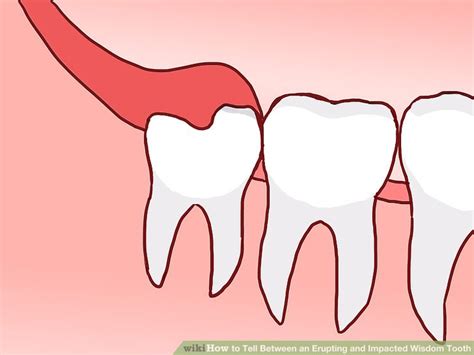 How To Tell Between An Erupting And Impacted Wisdom Tooth 9 Steps