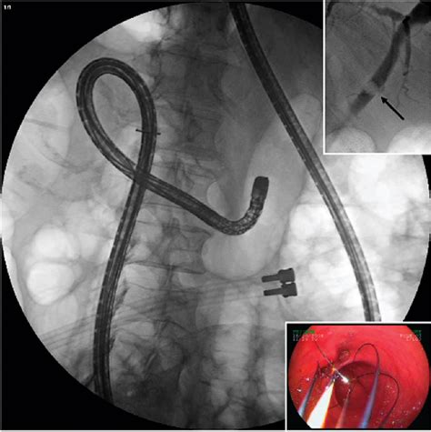 Figure 2 From Double Balloon Enteroscopy A Useful Tool For Diagnostic