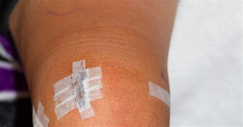 How much does torn meniscus treatment cost? Evening Birdsong: Essential Oils for Knee Surgery Relief