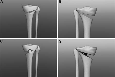 Effect Of The Osteotomy Length On The Change Of The Posterior Tibial