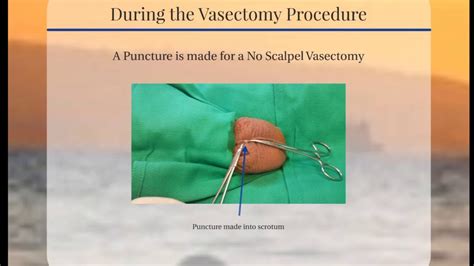Vasectomy Procedure