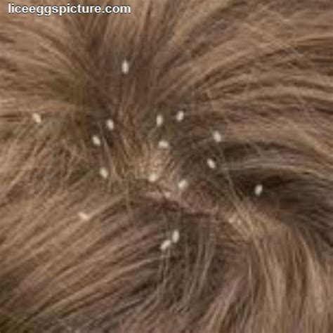 Head Lice Or Nits Rid Hair And Scalp Of These Biting Insects With