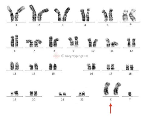 A Karyotype Of Klinefelter Syndrome Explained KaryotypingHub 900 The