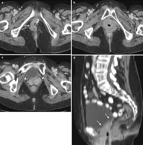  squamous carcinoma 83.87% versus 82.7%. Vulvar Cancer | Radiology Key