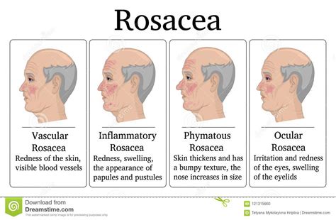 Pickelartige beulen sind ebenfalls möglich. Illustration von Rosacea vektor abbildung. Illustration von schmerz - 121315660