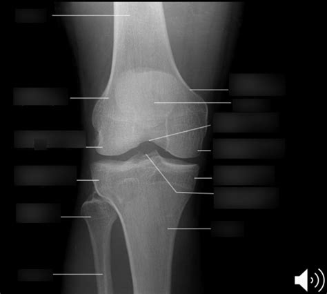 Radiology Of The Knee Diagram Quizlet
