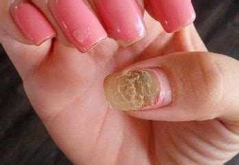 Fungal treatments do not work if the acrylic nail is still attached. 7 Tips to Treat Nail Fungus Caused by Acrylic Nails ...