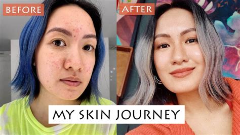 My Worst Skin Acne Journey How I Got Rid Of It Laureen Uy Youtube