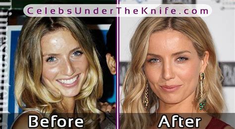 Annabelle Wallis Nose Job Photos Nose Job Celebrity Surgery