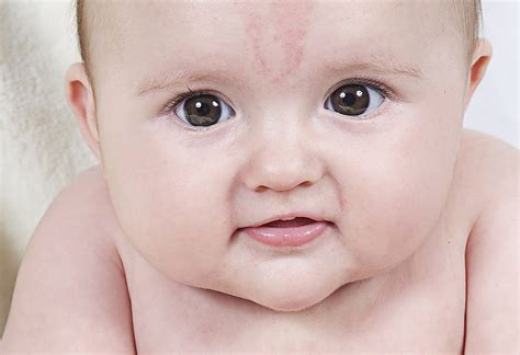 The Science Of Birthmarks Is Not Entirely Understood Especially Why