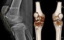 Cureus Neglected Rupture Of The Patellar Tendon After Fixation Of
