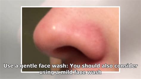 Causes Of Redness Around Nose And How To Get Rid Of Redness Around Nose