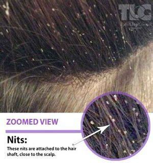 Head Lice In Adults With Color Treated Hair | Head louse ...