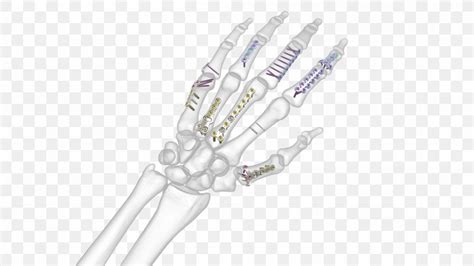 Hand Bone Fracture Synthes Metacarpal Bones Anatomy Png 4000x2250px