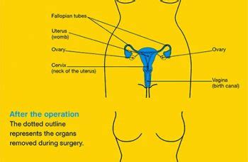 Although the exact causes of uterine cancers are not known, risk factors include women with endometrial overgrowth (hyperplasia), obesity, women who have never had children, menses beginning before age 12, menopause after age 55, estrogen therapy, taking tamoxifen, radiation to the pelvis, family history of uterine cancer, and lynch syndrome (most commonly seen as a form of inherited colorectal cancer). Can Uterine Cancer Be Detected In A Blood Test - Cancer ...