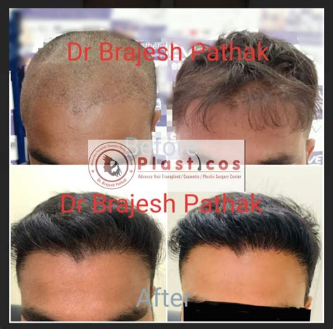 Gallery Dr Brajesh Pathak Plasticos Best Hair Treatment