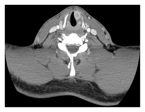 Axial A And Sagittal B Ct Of The Avidly Enhancing Mass In The