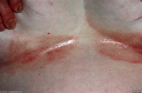 Intertrigo is an infection of the skin. Smetplekken / Intertrigo - Huidarts.com
