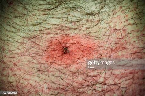 Deer Tick Bite Photos And Premium High Res Pictures Getty Images