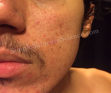 Folliculitis On Face Treatment Doctor Heck