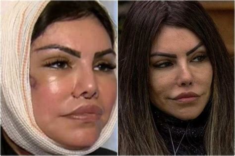 Top Liziane Gutierrez Antes E Depois Cirurgia
