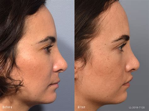 If the cost of a lip lift is more than you can afford, ask your surgeon about payment plans or visit our plastic surgery financing page. Lip Lift Before and After 01 | Pearlman Aesthetic Surgery