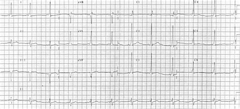 Electrocardiography is the process of producing an electrocardiogram (ecg or ekg). ~Dr Wannabees 5½ år: Blodgas, EKG och hjärtstopp