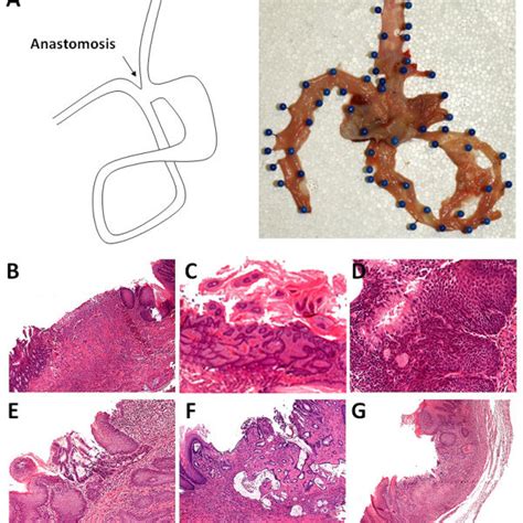 Pathology Findings Of The Esophageal Cancer Model A Schematic