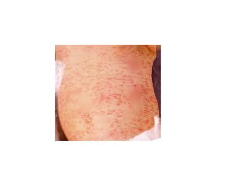 Figure Erythema Toxicum Image Courtesy O Chaigasame StatPearls NCBI Bookshelf