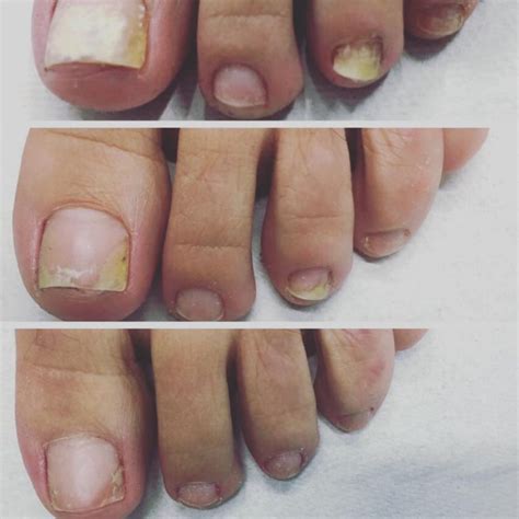 Black toenail fungus, also known as onychomycosis, is a type of fungus that usually infects toenails, though can affect fingernails alike. Nail Fungus - Vivo! MedSpa and Wellness Institute
