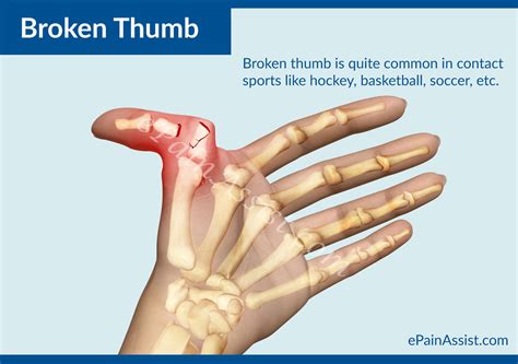 Other common causes include wrist injury, arthritis, and gout. PHOTO GALLERY - LIFEGUARDING DOWNERS GROVE SOUTH