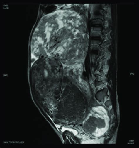 A Sagittal T Magnetic Resonance Image Showing The Same Mass Extending Download Scientific