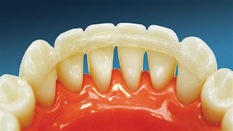 How to strengthen teeth roots. Dental Splinting - Conservative approach to strengthen ...