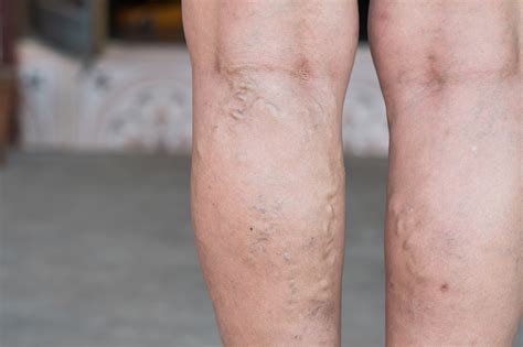 How Vein Stripping Is Used For Removal Of Varicose Veins