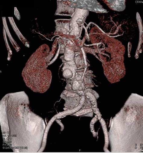 Abdominal Aortic Aneurysm And Focal Dissection Vascular Case Studies