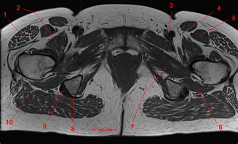Anatomie IRM de la hanche