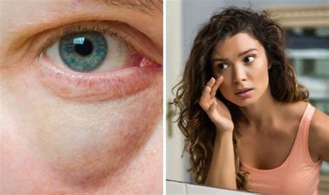 how to get rid of puffy or swollen eyes the simple tips uk