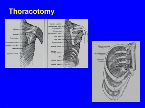 Ppt Thoracic Surgery Powerpoint Presentation Free Download Id6769714