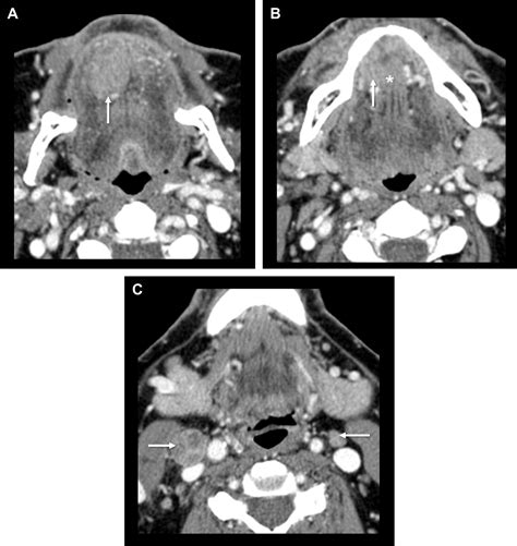 Pitfalls In The Staging Of Cancer Of Oral Cavity Cancer Neuroimaging