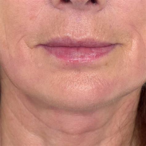 How To Treat Vertical Lines Above Lips