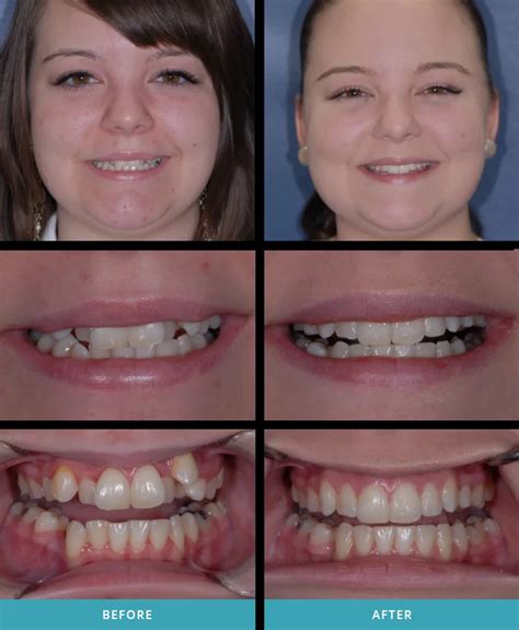 Before And After Invisalign Cases