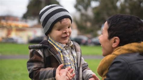 Boy Born With No Face Has Extreme Life Changing Surgery Nz Herald