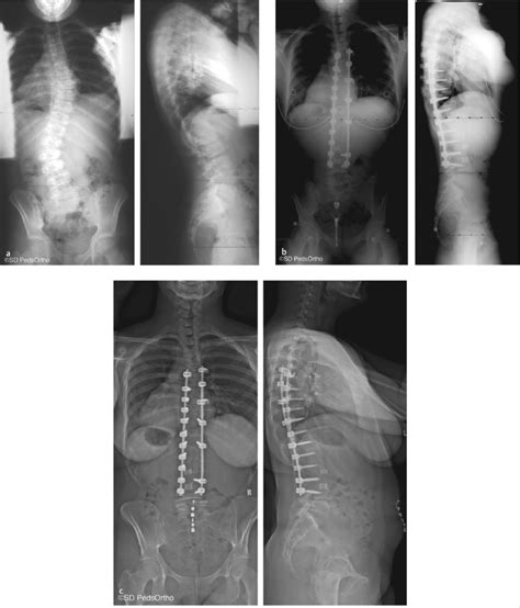 22 Long Term Clinical And Radiographic Outcomes Of Scoliosis